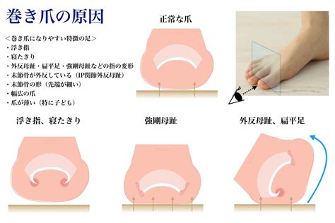 巻き爪の原因・予防・切り方・処置― 当院でのご説明について。 午前中の巻き爪矯正外来に来院されるようにお願い申し上げます。 その他の時間は診察の合間に行いますので、なるべく平日にご来院ください。。 ※ 癌 爪の変形 - Hello Doctor