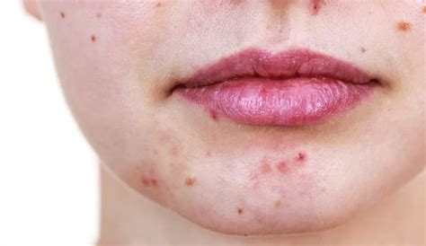 Does Adapalenebenzoyl Peroxide Gel Prevent Scar Worsening In Acne