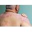 What Is Psoriasis And How Do I Know If Have It  Get Healthy Stay