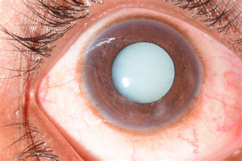 Adult Cataract Aravind Eye Care System