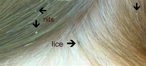 How To Check For Lice And How To Get Rid Of It