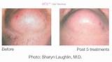 Images of How Many Treatments Does It Take For Laser Hair Removal