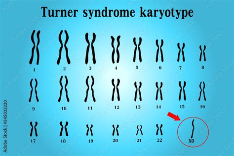Karyotype Of Turner Syndrome TS Also Known X Or X Is A Genetic Condition In Which A