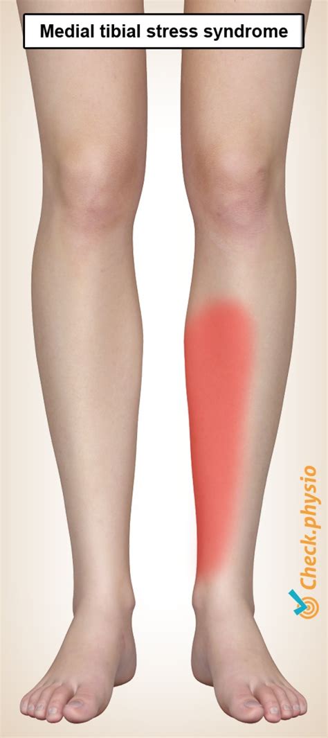 48 Best Bilder Pain On Inner Side Of Shin Bone Lower Leg Pain After