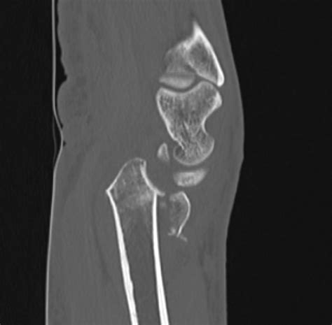 Fracture Osteotomy Distal Radius