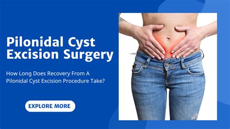 How Long Does Recovery From A Pilonidal Cyst Excision Procedure Take Atoallinks