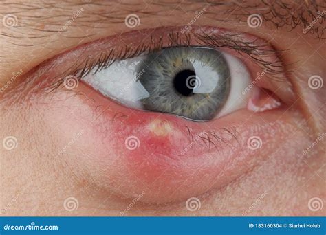 Close Up Abscess In The Eye Hordeolum Stybarley On The Eye