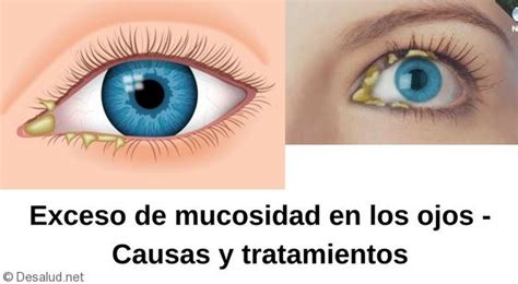 Secreción Ocular Mucosidad En Los Ojos Causas Tratamientos Temas De Belleza