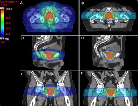 Protons The COMPARRE Trial Proton Vs IMRT For Prostate Cancer