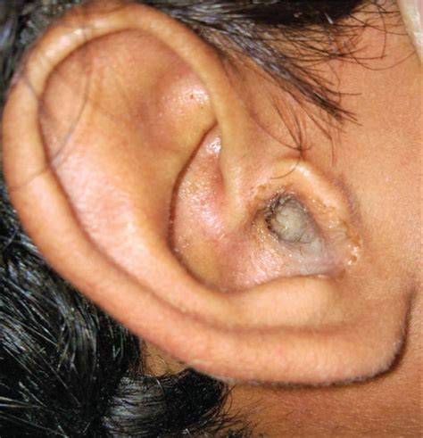 Pus In Ear Condition Signs Treatment And More Healthpulls