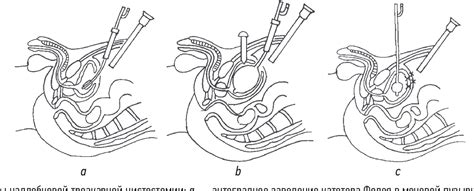 Figure 3 From Features Of The Installation Of A Suprapubic Cystostomy