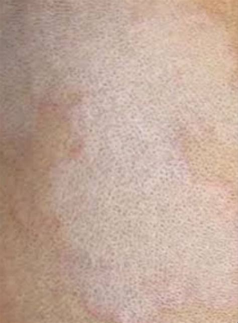 Seborrheique Dermatite Eczéma Séborrhéique Pityrosporose Santé Médecine