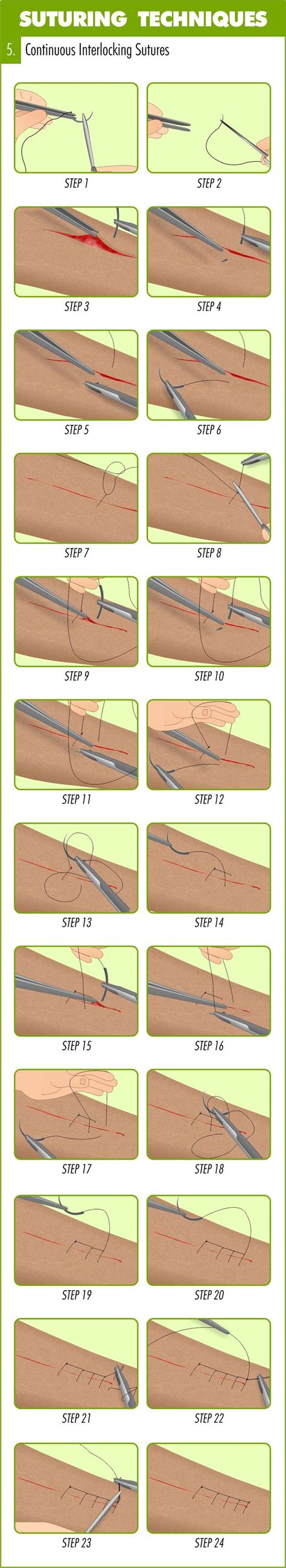 Complete Guide To Mastering Suturing Techniques Suture Techniques