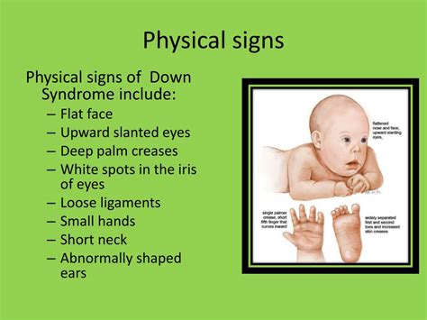 Ppt Down Syndrome Powerpoint Presentation Free Download Id4160941