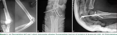 Figure 1 From Percutaneous K Wire Fixation In Paediatric Supracondylar