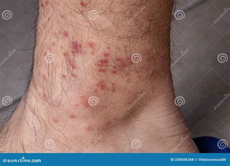 Allergic Reactions To Tick Bites Stock Photo Image Of Health