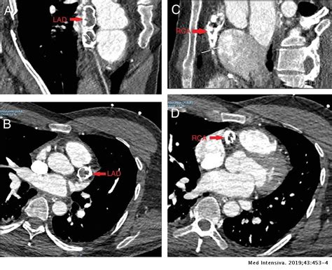 Coronary Aneurysm With Calcification In A Young Adult An Unusual Cause