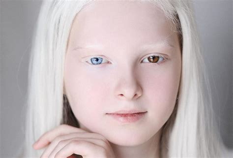 Garota Com Albinismo E Heterocromia Está Conquistando A Internet Por