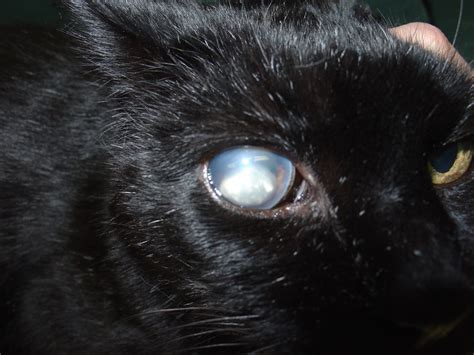 Healthy eyes have a balance of fluid and drainage. Ectopia lentis - wikidoc