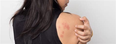 Struggling With Persistent Itchy Rashes A Patch Test Could Reveal