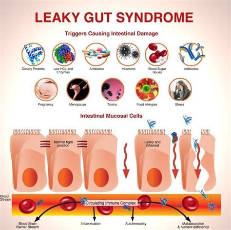 Leaky Gut Syndrome Leaky Gut Syndrome Heal Leaky Gut Leaky Gut