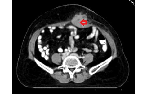 Case 1 Ct Image Of Abdominal Wall Metastasis Red Arrow Download