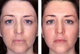 Photos of Medical Grade Facial Peel