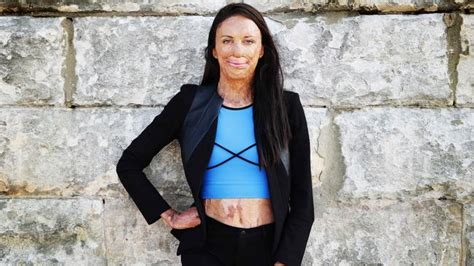 Turia Pitt Says Constant Surgery Now Feels Just Like Housework