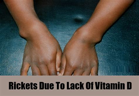 5 Signs And Symptoms Indicating Lack Of Vitamin D Search Home Remedy