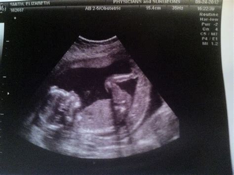 Out Of The Blue 17 Week Update And Anatomy Ultrasound