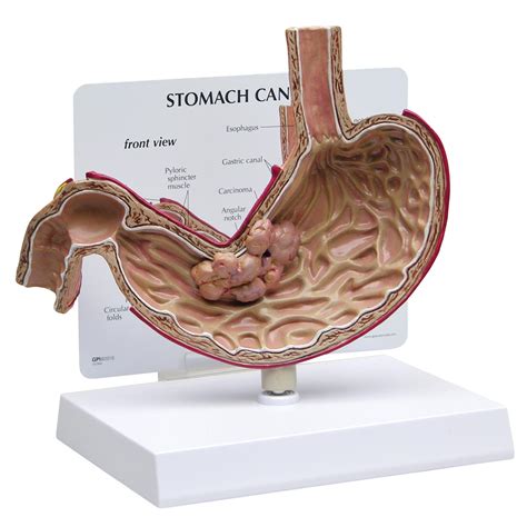 Stomach Cancer Model 1019524 2001 Anatomical Models Anatomy