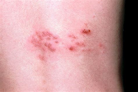 Painful Shingles Can Strike More Than Once Wsj