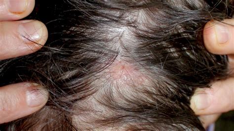 Alopecia Bald Spot Vlrengbr