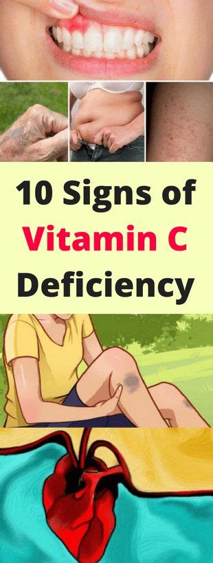 Here Signs Of Vitamin C Deficiency Health Recipes