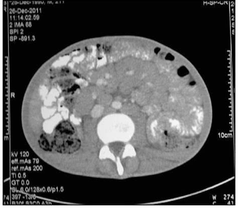 Ct Scan Transverse Section Showing Lymphadenopathy In The Abdomen