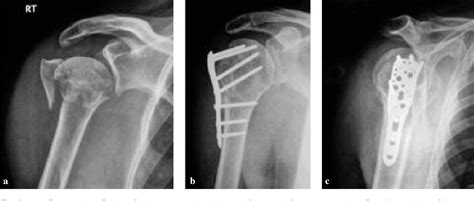 Pdf Outcome Of Proximal Humerus Fractures Treated By Philos Plate My