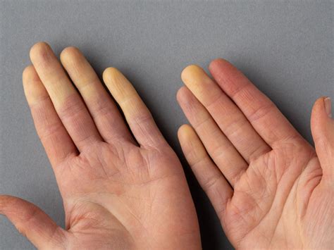 What Is Raynauds And What Can You Do About It
