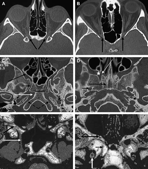 Imaging Of The Central Skull Base Neuroimaging Clinics
