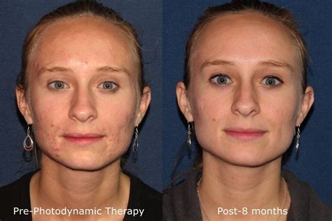 Photodynamic Therapy Pdt San Diego Ca Cosmetic Laser Dermatology