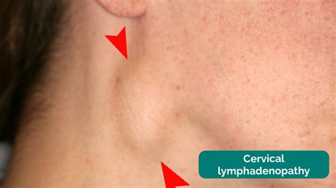 Lymph Node Lump On Neck