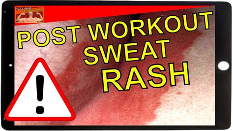 How To Treat Sweat Rash Youtube