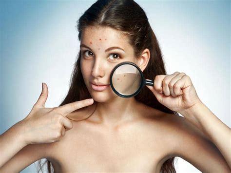 How To Treat Oily Skin Pimples At Home Causes And Remedies