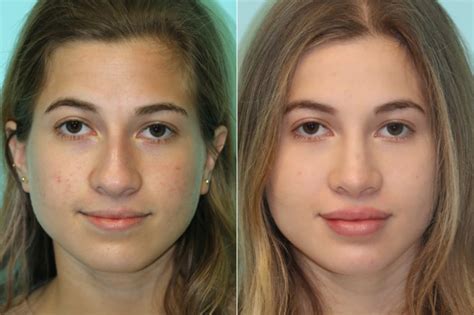 Lip Augmentation Photos Chevy Chase Md Patient 21613
