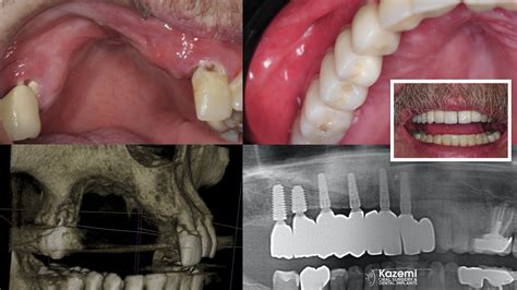 Solutions For Patients With Severe Bone Loss Who Want Dental Implants