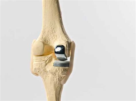 Partial Knee Replacement Minimally Invasive Knee Surgery