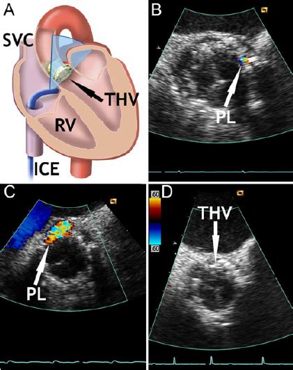 Transventricular View With The Catheter In The Right Ventricle And The