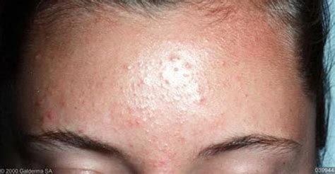 Are Those Bumps On Your Skin Fungal Acne By Nudie Glow Medium