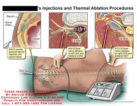 Amicus Illustration Of Amicus Injection Thermal Ablation Procedures