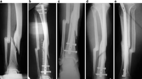 A Closed Tibial Fracture At The Site Of A Previous Malu Open I