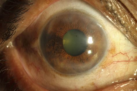 Phfi Cehj Herpes Simplex Infection Of The Eye An Introduction